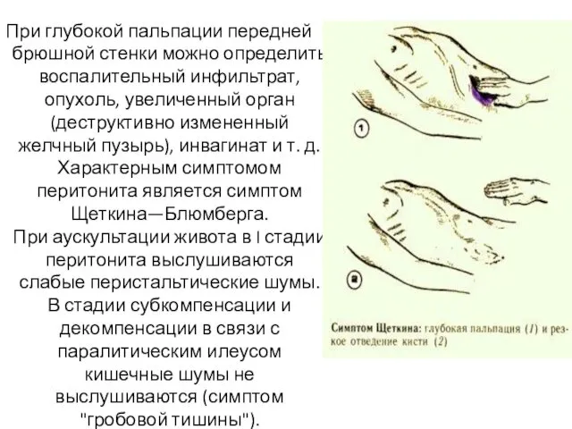 При глубокой пальпации передней брюшной стенки можно определить воспалительный инфильтрат, опухоль,