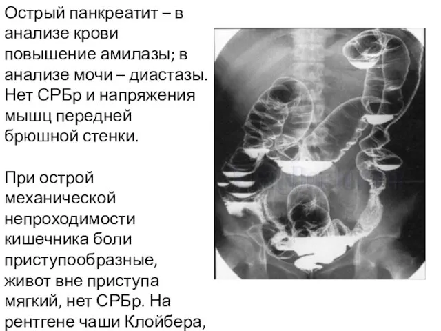 Острый панкреатит – в анализе крови повышение амилазы; в анализе мочи