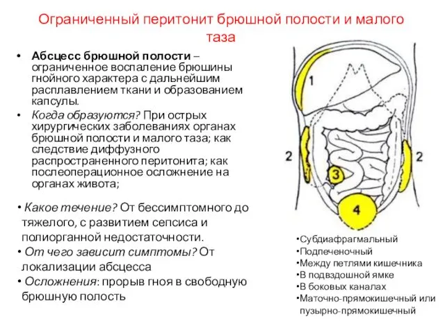 Ограниченный перитонит брюшной полости и малого таза Абсцесс брюшной полости –