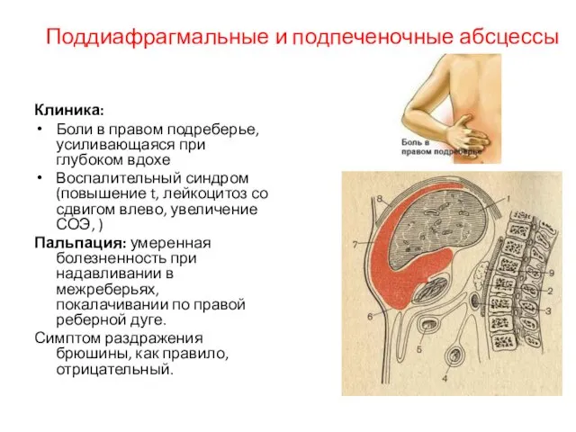 Поддиафрагмальные и подпеченочные абсцессы Клиника: Боли в правом подреберье, усиливающаяся при