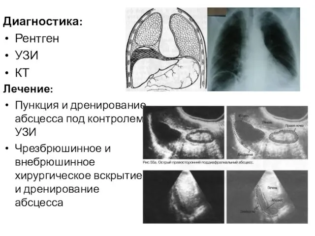 Диагностика: Рентген УЗИ КТ Лечение: Пункция и дренирование абсцесса под контролем