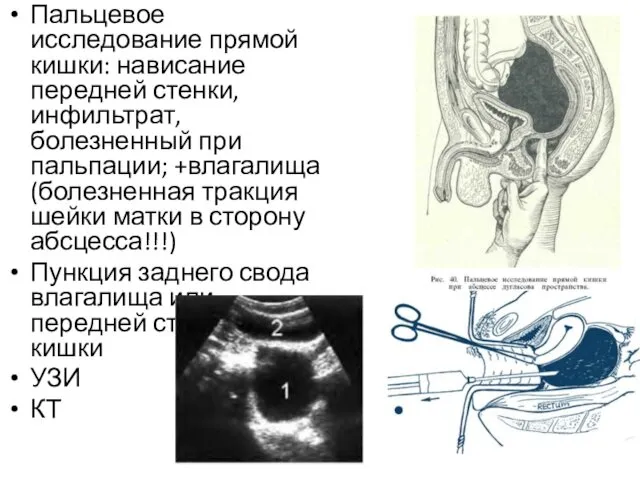 Пальцевое исследование прямой кишки: нависание передней стенки, инфильтрат, болезненный при пальпации;