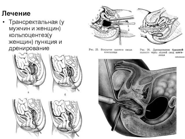 Лечение Трансректальная (у мужчин и женщин) кольпоцентез(у женщин) пункция и дренирование абсцесса