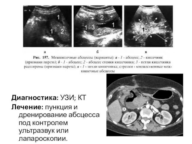 Диагностика: УЗИ; КТ Лечение: пункция и дренирование абсцесса под контролем ультразвук или лапароскопии.
