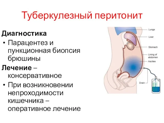 Туберкулезный перитонит Диагностика Парацентез и пункционная биопсия брюшины Лечение – консервативное