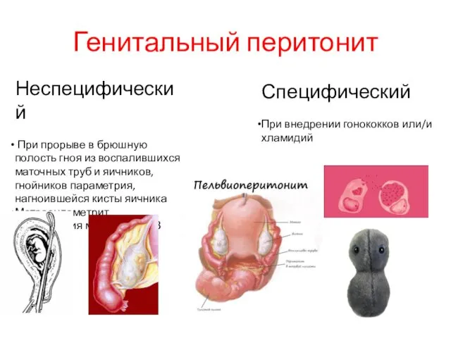 Генитальный перитонит Неспецифический При прорыве в брюшную полость гноя из воспалившихся