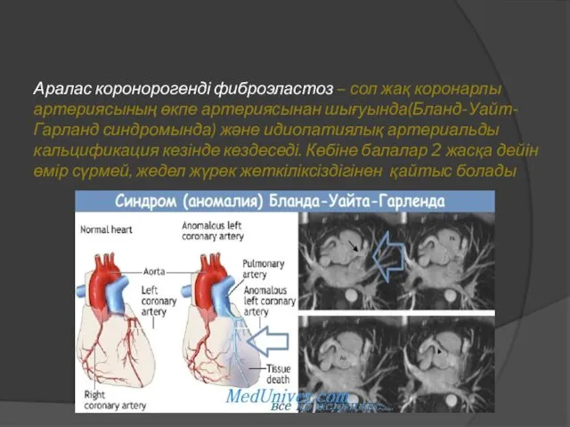 Аралас коронорогенді фиброэластоз – сол жақ коронарлы артериясының өкпе артериясынан шығуында(Бланд-Уайт-Гарланд