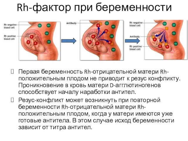 Rh-фактор при беременности Первая беременность Rh-отрицательной матери Rh-положительным плодом не приводит