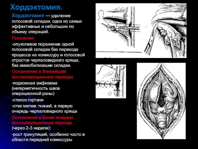 Хордэктомия. Хордэктомия — удаление голосовой складки, одна из самых эффективных и