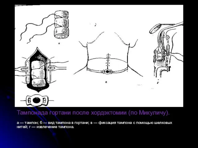 Тампонада гортани после хордэктомии (по Микуличу). а — тампон; б —