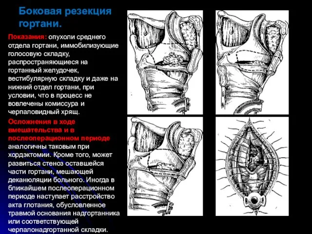 Боковая резекция гортани. Показания: опухоли среднего отдела гортани, иммобилизующие голосовую складку,