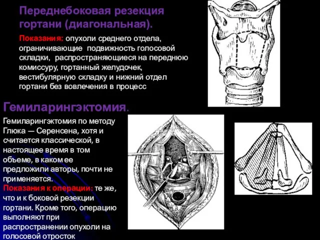 Переднебоковая резекция гортани (диагональная). Показания: опухоли среднего отдела, ограничивающие подвижность голосовой