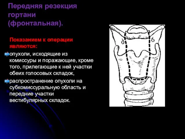 Передняя резекция гортани (фронтальная). Показанием к операции являются: опухоли, исходящие из