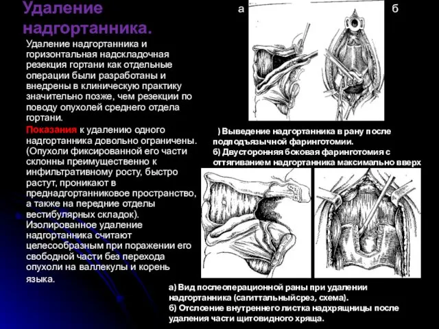 Удаление надгортанника. Удаление надгортанника и горизонтальная надскладочная резекция гортани как отдельные