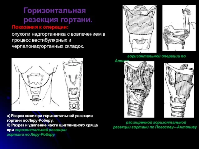 Горизонтальная резекция гортани. Показания к операции: опухоли надгортанника с вовлечением в