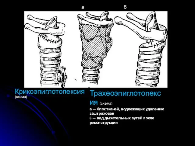 Крикоэпиглотопексия (схема) Трахеоэпиглотопексия (схема) а — блок тканей, подлежащих удалению заштрихован