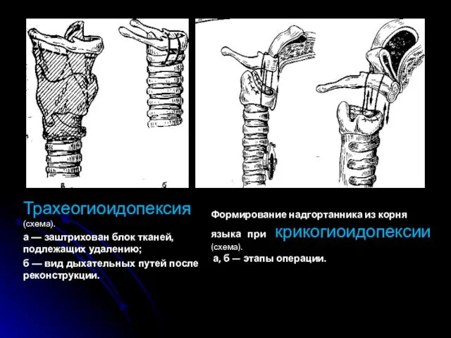 Трахеогиоидопексия (схема). а — заштрихован блок тканей, подлежащих удалению; б —