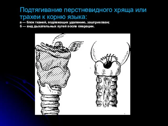 Подтягивание перстневидного хряща или трахеи к корню языка: а — блок