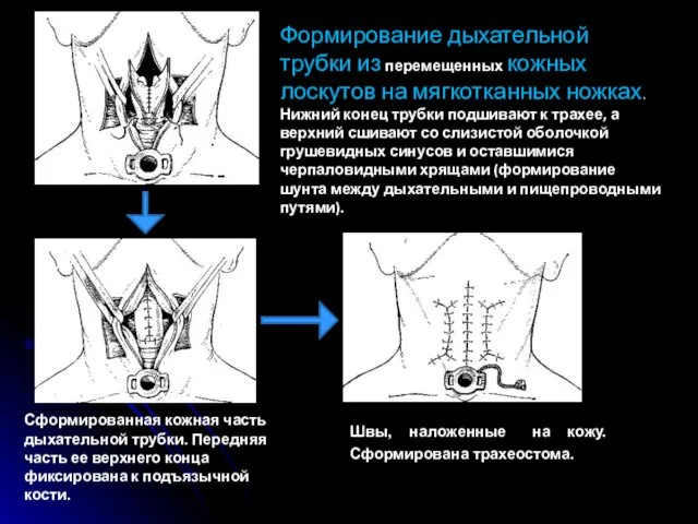 Швы, наложенные на кожу. Сформирована трахеостома. Формирование дыхательной трубки из перемещенных