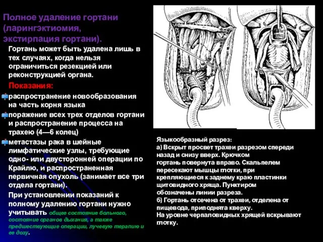 Полное удаление гортани (ларингэктиомия, экстирпация гортани). Гортань может быть удалена лишь