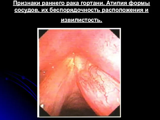 Признаки раннего рака гортани. Атипия формы сосудов, их беспорядочность расположения и извилистость.