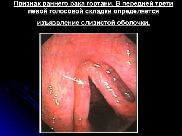 Признак раннего рака гортани. В передней трети левой голосовой складки определяется изъязвление слизистой оболочки.