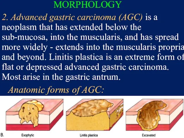 MORPHOLOGY 2. Advanced gastric carcinoma (AGC) is a neoplasm that has