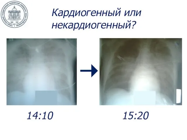 14:10 15:20 Кардиогенный или некардиогенный?