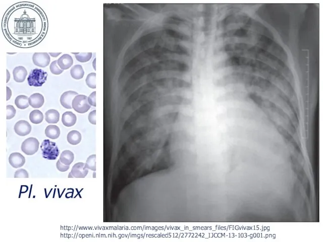 http://openi.nlm.nih.gov/imgs/rescaled512/2772242_IJCCM-13-103-g001.png http://www.vivaxmalaria.com/images/vivax_in_smears_files/FIGvivax15.jpg Pl. vivax