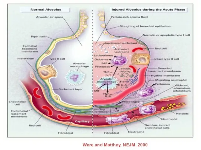 Ware and Matthay, NEJM, 2000