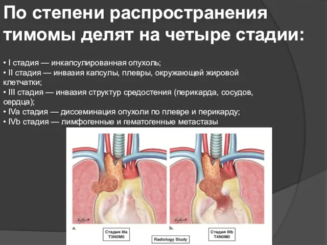 • I стадия — инкапсулированная опухоль; • II стадия — инвазия