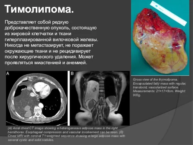 Представляет собой редкую доброкачественную опухоль, состоящую из жировой клетчатки и ткани