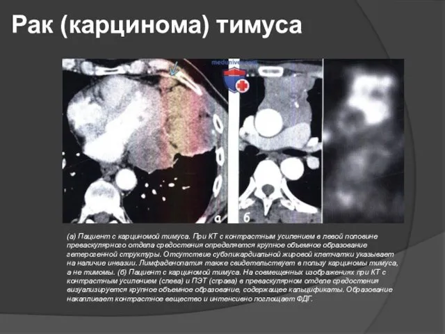 Рак (карцинома) тимуса (а) Пациент с карциномой тимуса. При КТ с