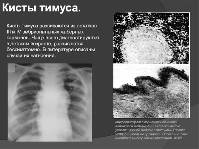 Кисты тимуса развиваются из остатков III и IV эмбриональных жаберных карманов.