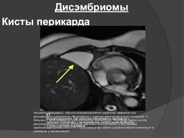 Дисэмбриомы Кисты перикарда На рентгенографии обычно визуализируется округлое, овальное или грушевидное