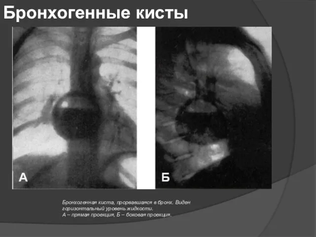 Бронхогенные кисты Бронхогенная киста, прорвавшаяся в бронх. Виден горизонтальный уровень жидкости.