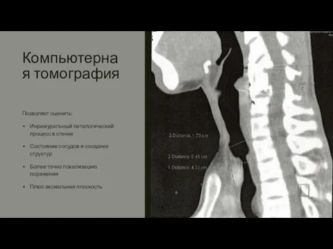 Компьютерная томография Позволяет оценить: Инрамуральный паталогический процесс в стенке Состояние сосудов