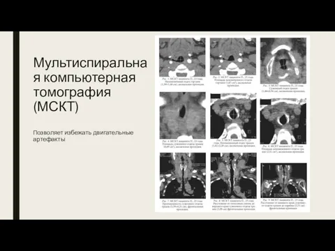 Мультиспиральная компьютерная томография (МСКТ) Позволяет избежать двигательные артефакты