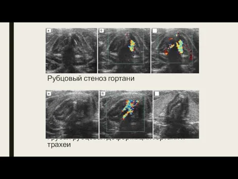 Рубцовый стеноз гортани Грубая рубцовая деформация гортани и трахеи