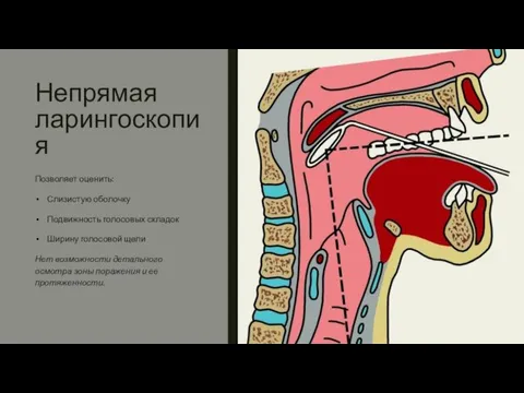 Непрямая ларингоскопия Позволяет оценить: Слизистую оболочку Подвижность голосовых складок Ширину голосовой