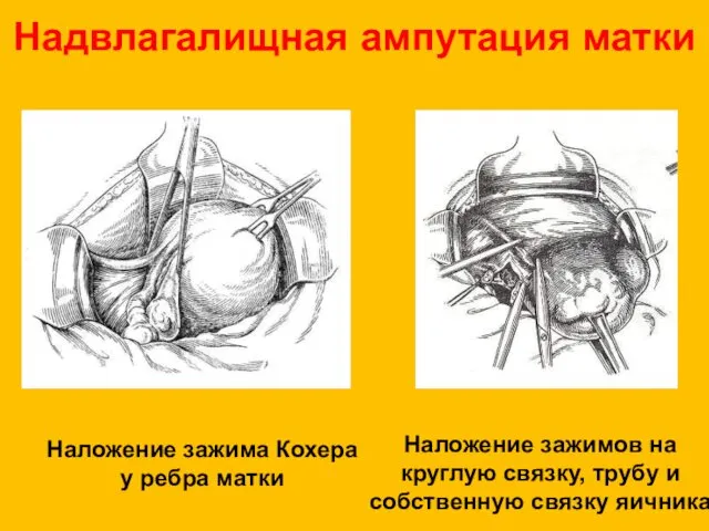 Надвлагалищная ампутация матки Наложение зажима Кохера у ребра матки Наложение зажимов