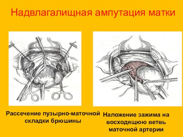 Надвлагалищная ампутация матки Рассечение пузырно-маточной складки брюшины Наложение зажима на восходящюю ветвь маточной артерии