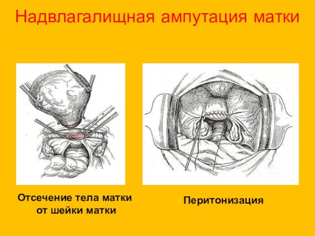 Надвлагалищная ампутация матки Отсечение тела матки от шейки матки Перитонизация