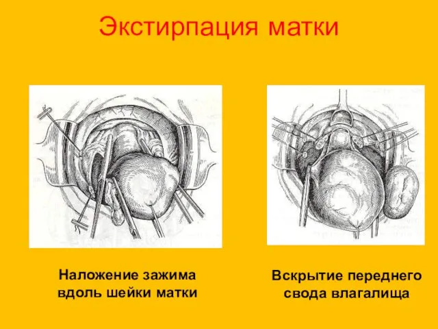 Экстирпация матки Наложение зажима вдоль шейки матки Вскрытие переднего свода влагалища