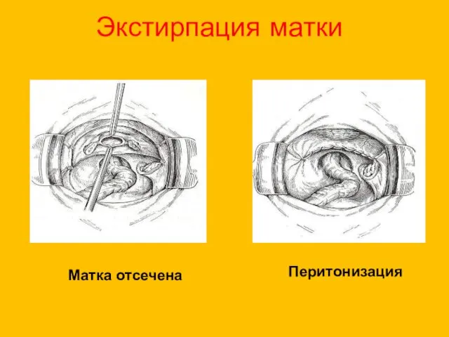 Экстирпация матки Матка отсечена Перитонизация