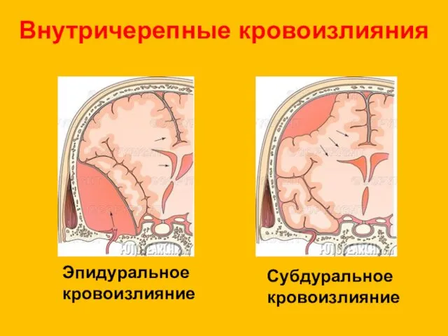 Внутричерепные кровоизлияния Эпидуральное кровоизлияние Субдуральное кровоизлияние