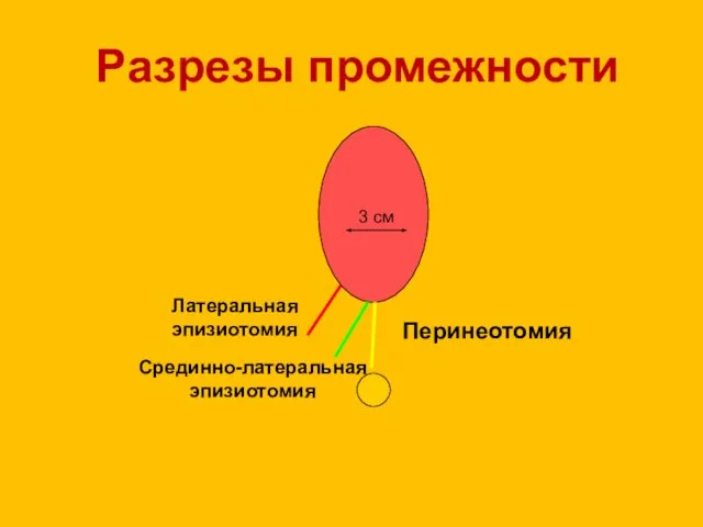 Разрезы промежности Перинеотомия Латеральная эпизиотомия Срединно-латеральная эпизиотомия 3 см