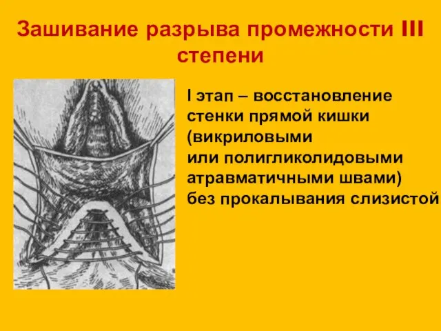 Зашивание разрыва промежности III степени I этап – восстановление стенки прямой