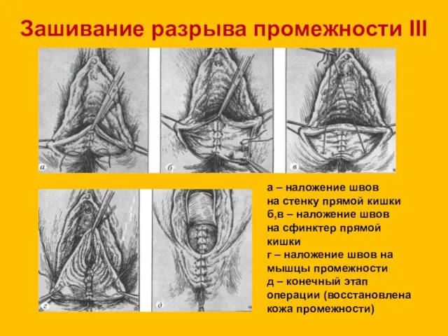 Зашивание разрыва промежности III степени а – наложение швов на стенку