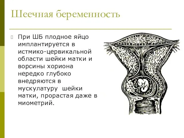 Шеечная беременность При ШБ плодное яйцо имплантируется в истмико-цервикальной области шейки